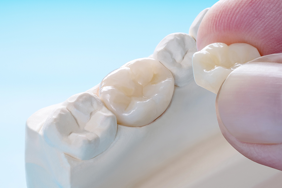 補綴治療（つめ物・かぶせ物）